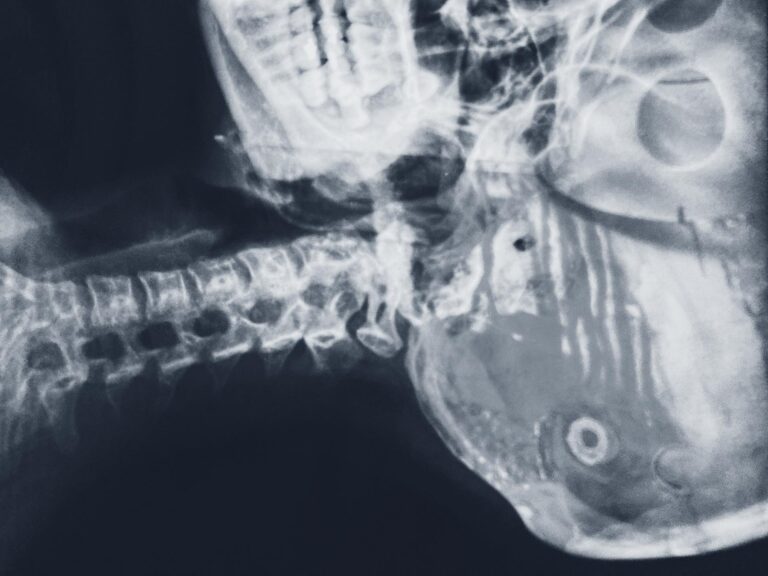 Average Car Accident Settlements for Neck and Back Injuries (2026 Florida Update)